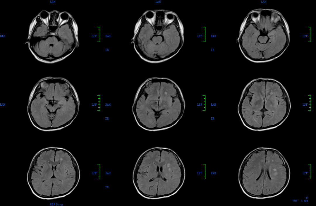 头颅mr:左侧额顶叶,基底节区及放射冠多发脑梗死.
