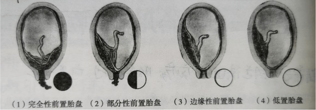 在產檢時,我們最常聽到醫生說的是胎盤低.