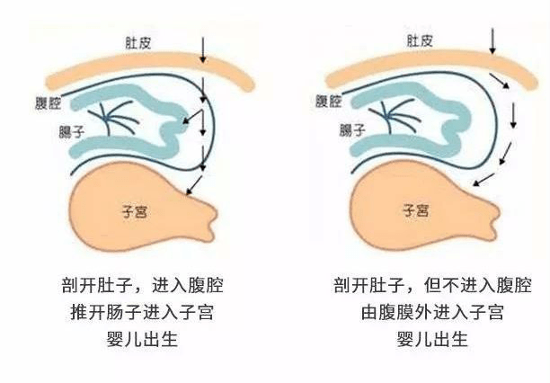 揭秘:腹膜外剖宫产,奚梦瑶称剖腹产没感觉引争议