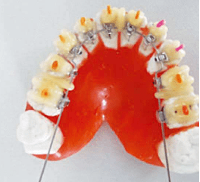舌側排牙 託槽弓絲定位操作步驟_樹脂_mm_模型