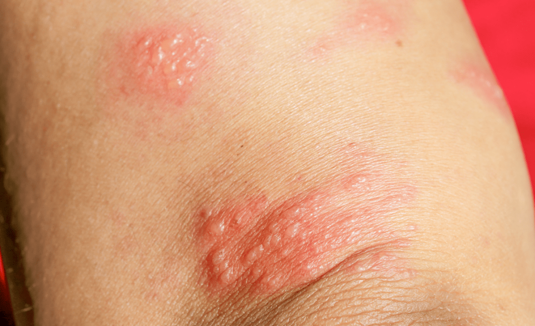 外阴湿疹是什么症状图片