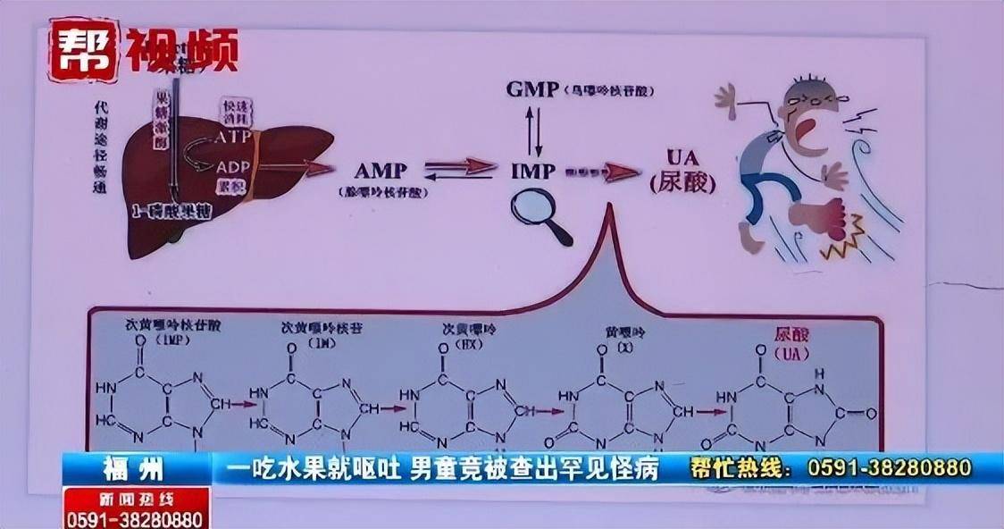 泛亚电竞男童一吃水果就呕吐竟被查出患罕见遗传病医生：严重可致命(图3)