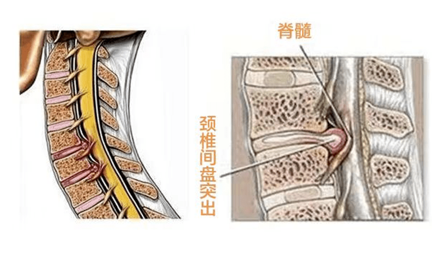 頸椎間盤突出_症狀_頸部_脊髓