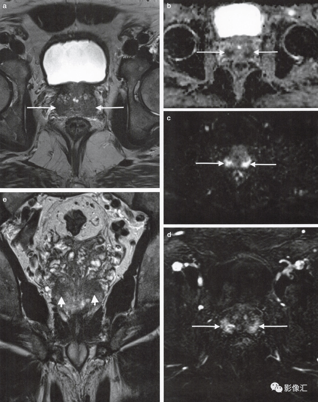 前列腺磁共振图像图片