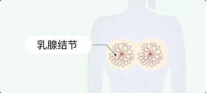 乳腺結節&免疫細胞_檢查_生活_內分泌