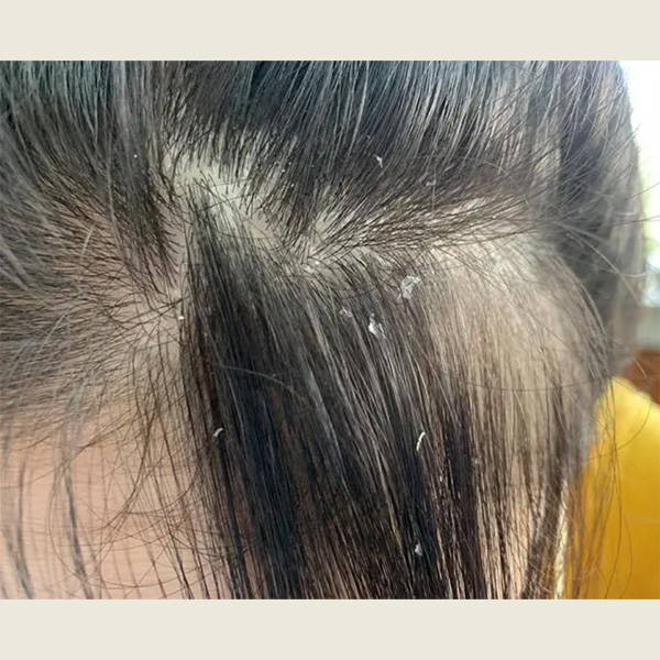 哪个洗发水去屑控油好?_头皮_问题_头发