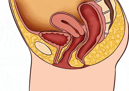 女性膀胱膨出图 子宫图片