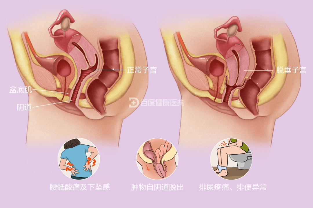 陰道_組織_宮頸