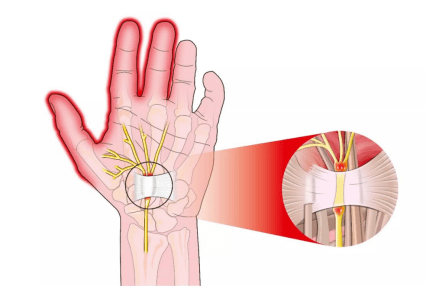 手指麻木,夜間痛醒,小心腕管綜合徵_患者_手術_治療