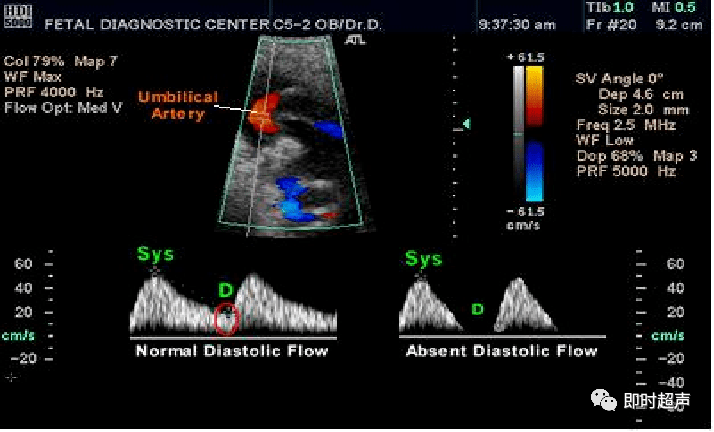胎兒血流多普勒超聲檢查_動脈_靜脈_大腦