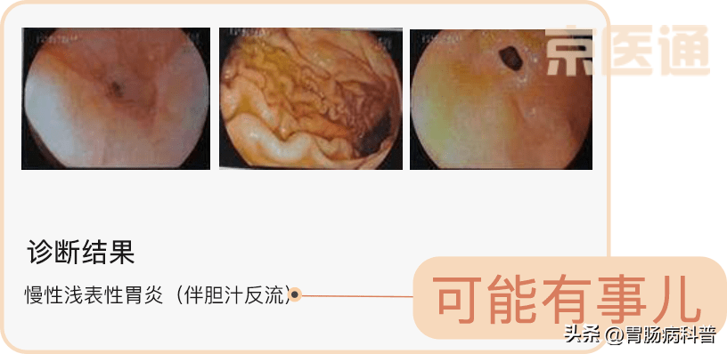 胃鏡檢查全攻略(收藏版)_食管_幽門_患者