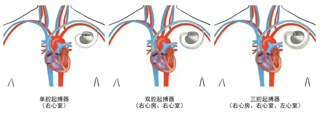 心脏起搏器多大图片图片